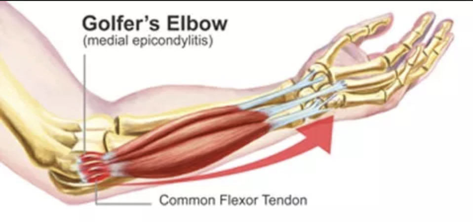 The Golfer's Guide to Tackling Elbow Woes with Chiropractic Care